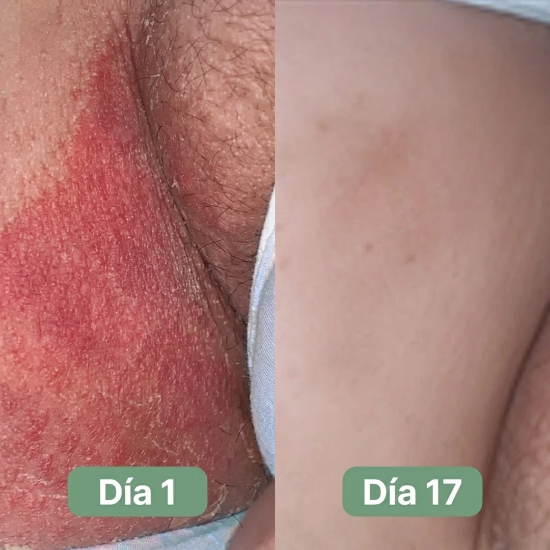 BUOMY Jabón Antihongos®