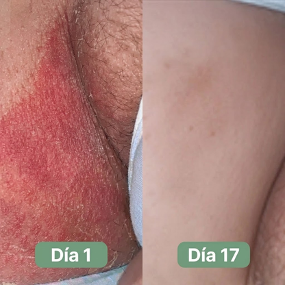 BUOMY Jabón Antihongos®